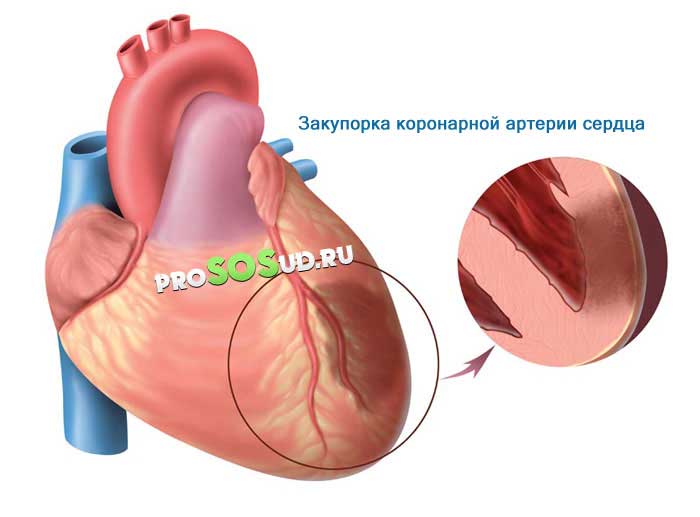 Закупорка коронарной артерии сердца