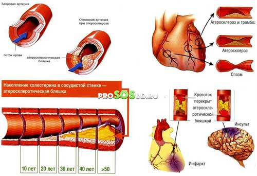 Риски сосудистых заболеваний