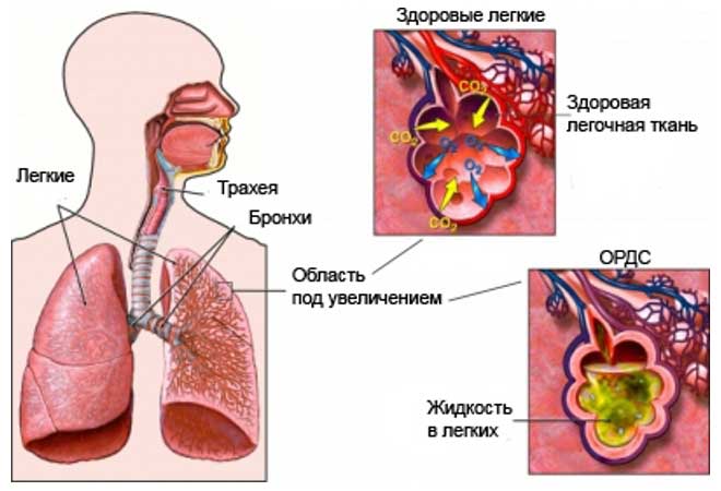 жидкость в лёгких