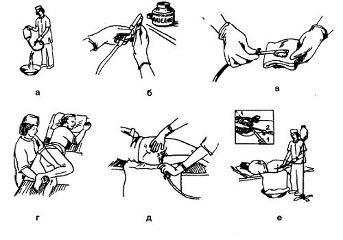 Алгоритм постановки клизмы