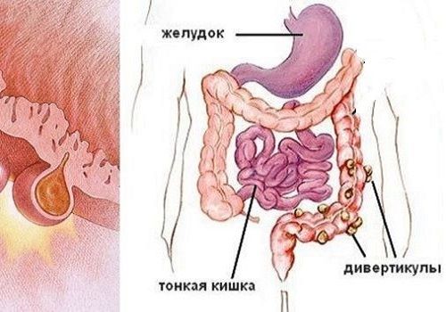 Дивертикулез кишечника