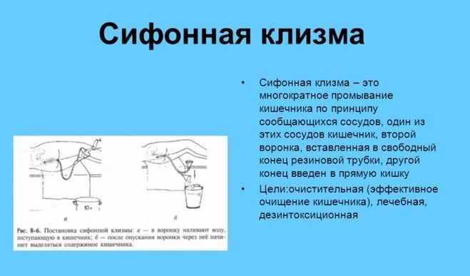 Сифонная клизма