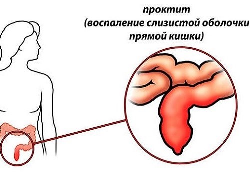 Локализация проктита