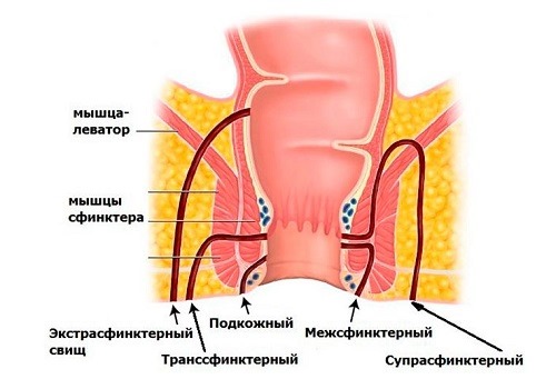 Виды свищей