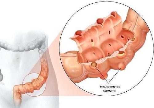 Дивертикулы в кишечнике