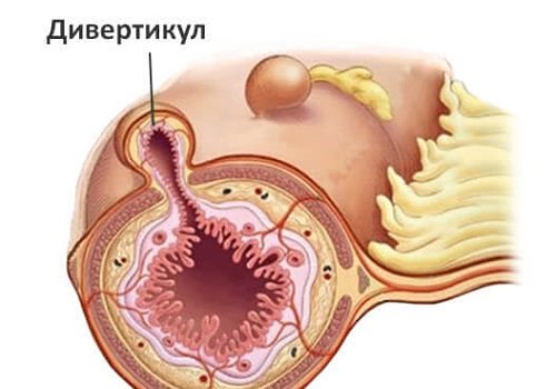 Дивертикулит кишечника