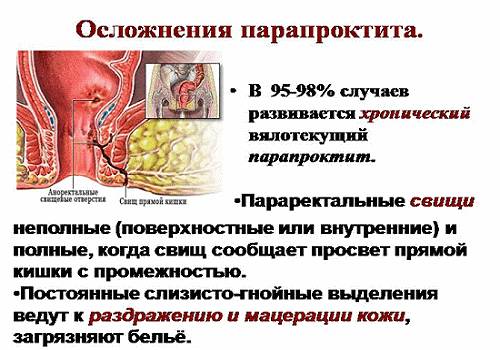 Осложнения парапроктита