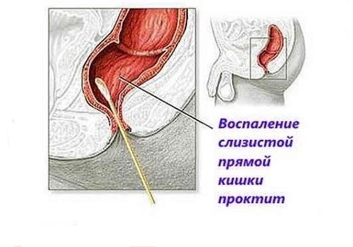 Локализация проктита