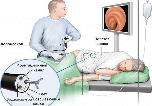 Колоноскопия кишечника