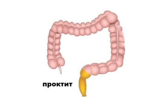 Локализация проктита