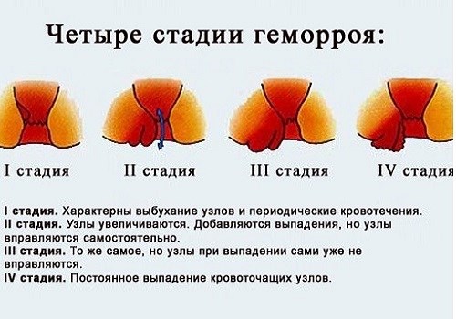 Стадии развития геморроя