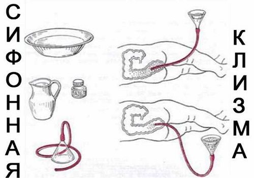 Принцип постановки сифонной клизмы